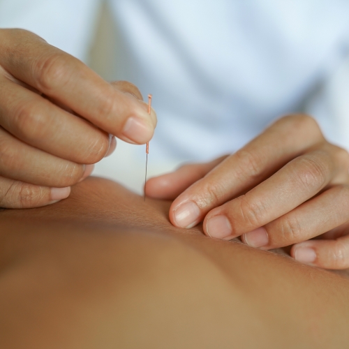 Dry-Needling-IMS-physiotherapy-image-Zenith-Physiotherapy-and-wellness-Airdrie-AB